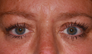 Ptosis Repair after