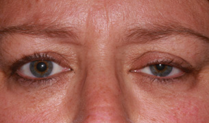 Ptosis Repair before