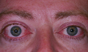 Thyroid Eye Disease before